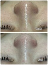 エンチャント(ENCHANT)/★ハイドラ毛穴洗浄★