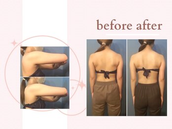 ミチ 整体サロン(michi)/ハイパーナイフ施術