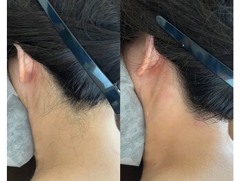 サロンドエピレーション トパーズ(Salon d’ epilation TOPARDS)/襟足スッキリで後ろ姿もキレイ☆