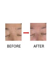 らたす(Ra+)/エレクトロポレーション施術後