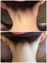 シェリー(cheri)/えり足脱毛