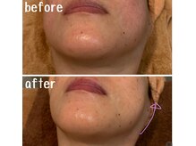 ラディアント(Radiant)/インディバ＆レモンボトル