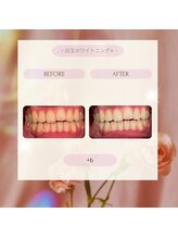プラスビー 2号店(+b)/ホワイトニングビフォーアフター
