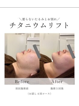 韓国肌管理室 ｍｏｍｏ【小顔/リフトアップ/肌質改善/痩身/脱毛】【8/1OPEN（予定）】の写真/韓国で大人気の《チタニウムリフト》を導入◇照射後から素早く効果を実感できる小顔リフト♪
