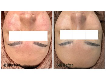 シエル ブルー(Ciel Blue)/赤み、アクネケア