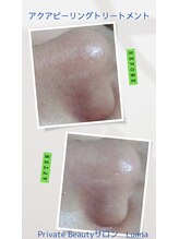 ルアナ(Luana)/美容液毛穴洗浄☆毛穴スッキリ♪