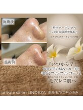 リンデザ(LINDEZA)/長年の毛穴のお悩み解決