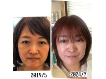 リバイヴ(Revive)の雰囲気（私の肌症例　本人の結果をサロンで確認してください）