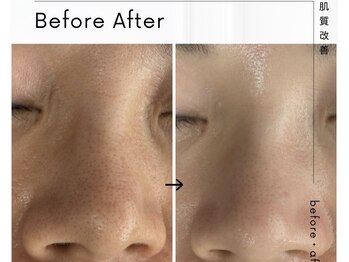 エミナル(EMINAL)/気になる毛穴ケア改善メニュー