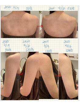 ラリリー(La Lily)/ブライダル二の腕・背中 肌改善