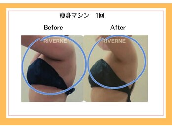 リヴェーヌ 富山店/トリプル痩身1回