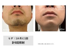 スタンド(STAND)の雰囲気（髭剃りいらず！すべすべ肌！　髭脱毛　初回2750円！）