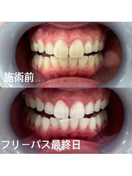 ホワイトニングサロン 熊本店/誰でもセルフホワイトニング