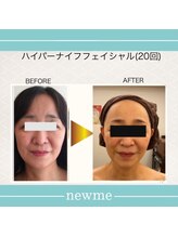 ニュウミー 諏訪本店(newme)/小顔　ビフォーアフター5