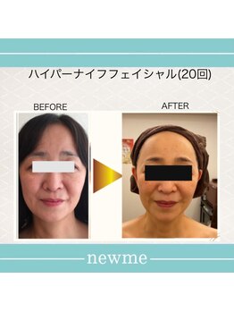 ニュウミー 諏訪本店(newme)/小顔　ビフォーアフター5