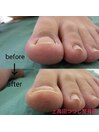 巻き爪　ネイルケア　例