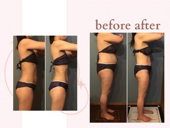 ミチ 整体サロン(michi)/ハイパーナイフ施術