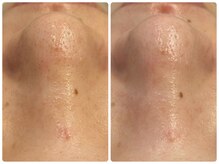 ヒスイ バイ アメイジング(Hisui by AMAZING)/【毛穴ケア】韓国式3D毛穴洗浄