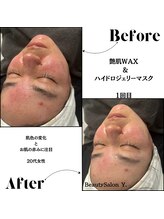 ワイドット(Y.)/1回でニ○ビの赤み鎮静成功