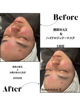 ワイドット(Y.)/1回でニ○ビの赤み鎮静成功