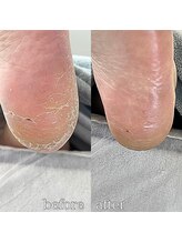 フットミー(foot mii)/踵ケア