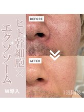 テセラ(Tethere)/ヒト幹細胞×エクソソーム