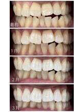 コナホワイトニング 神保町/経過観察
