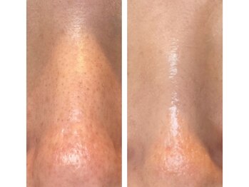 ミュウ 心斎橋店(MYU)/ハイドロフェイシャル/毛穴ケア