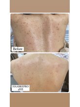 プラウディア(PROUDIA)/背中ケア/ブライダル背中ケア