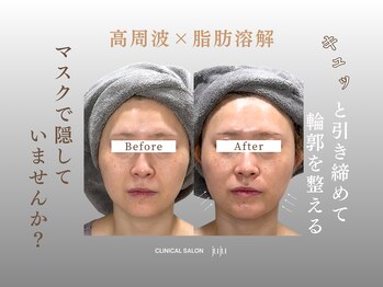 ジュジュ(juju)/顔下マスクで隠していませんか?