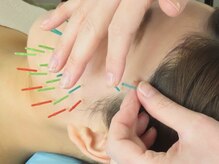 アオヤマ サロン ワイゼット(AOYAMA SALON YZ)/食いしばり・頭のコリにも美容鍼