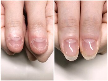 インブロッサム(imblossom)の写真/今度こそ本気で深爪を直したい・爪噛みや爪のむしり癖で爪が伸ばせない方必見！そのお悩み当店にお任せ☆
