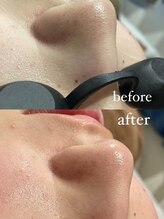 チル(chill)/ビフォーアフター