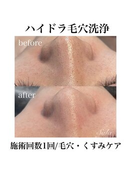 サラ/ハイドラ毛穴洗浄