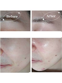 ソア(Soa)/ララピール