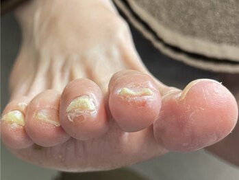 ミコ(.mico)の写真/【高リピート率の技術】深爪・巻き爪の矯正、変形した爪もお任せ。他で解決しなかったお悩みも当店へ◎