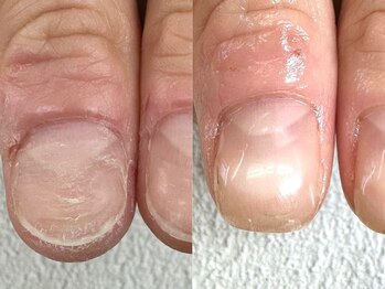 ネイルサロン ミノアッカ(mino'aka)の写真/「初めて前向きになれた」最短3ヶ月で長年のコンプレックスを"卒業"！極度の深爪・噛み爪はおまかせ！