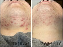 レイズ(RAISE)/当店人気No.1 水光ピーリング