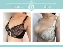 美人バスト 新潟店/ 【バストアップ★育乳】症例