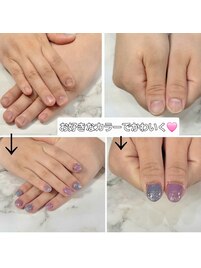 矯正後カラーでかわいく♪