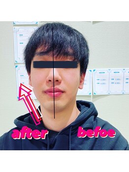 アイピー(I.P)/Before After