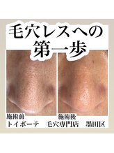 トイボーテ(toi beaute)/毛穴エクストラクションプロ