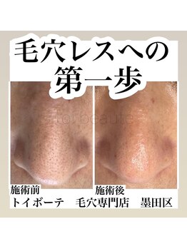 トイボーテ(toi beaute)/毛穴エクストラクションプロ