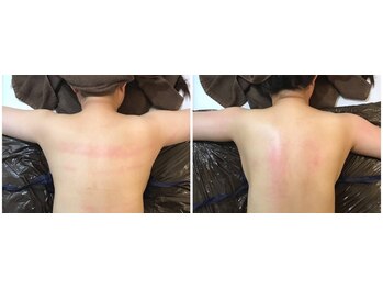 クレビオ/ハイパーナイフ　施術前→施術後