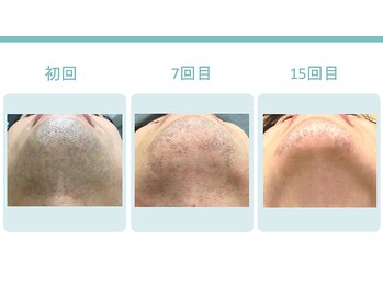 スターポルト(Star-Porte)/ヒゲ脱毛