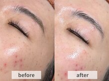 アルムボーテ 代官山 恵比寿(ARUIM Beaute)/シェービングビフォーアフター