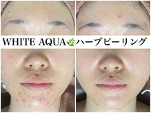 ホワイトアクア 広島店(WHITE AQUA)/ハーブピーリング/ニキビケア