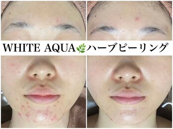 ホワイトアクア 広島店(WHITE AQUA)/ハーブピーリング/ニキビケア