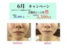 30名様限定★むくみ!! 脂肪燃焼!! 小顔水素フェイシャル水素吸入付