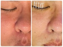 エステティックサロン ベルエトワール住吉店/ハイドロヴィーナス